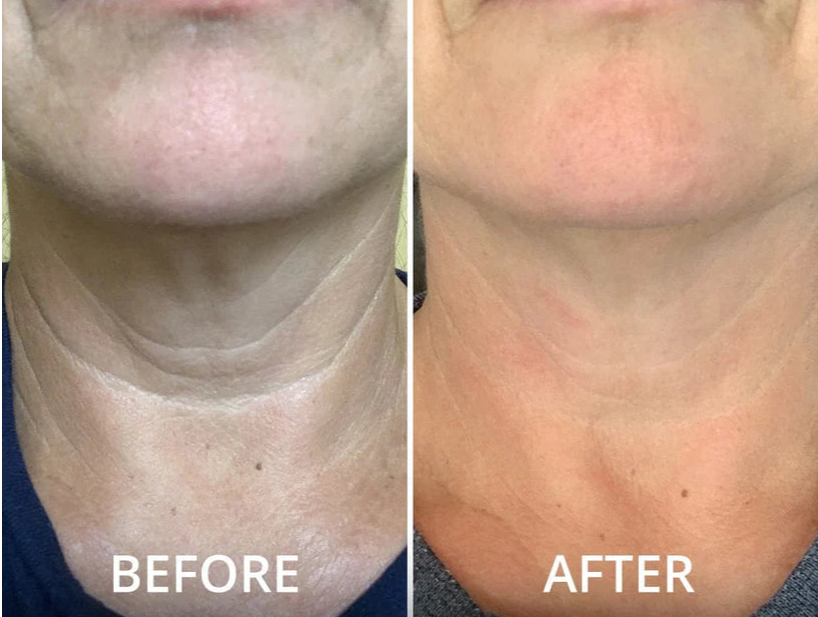 Neck Tightening Cream