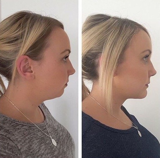 FaceLift Magic Belt